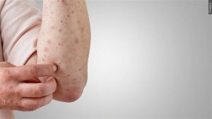Nebraskans encouraged to stay protected against Measles 